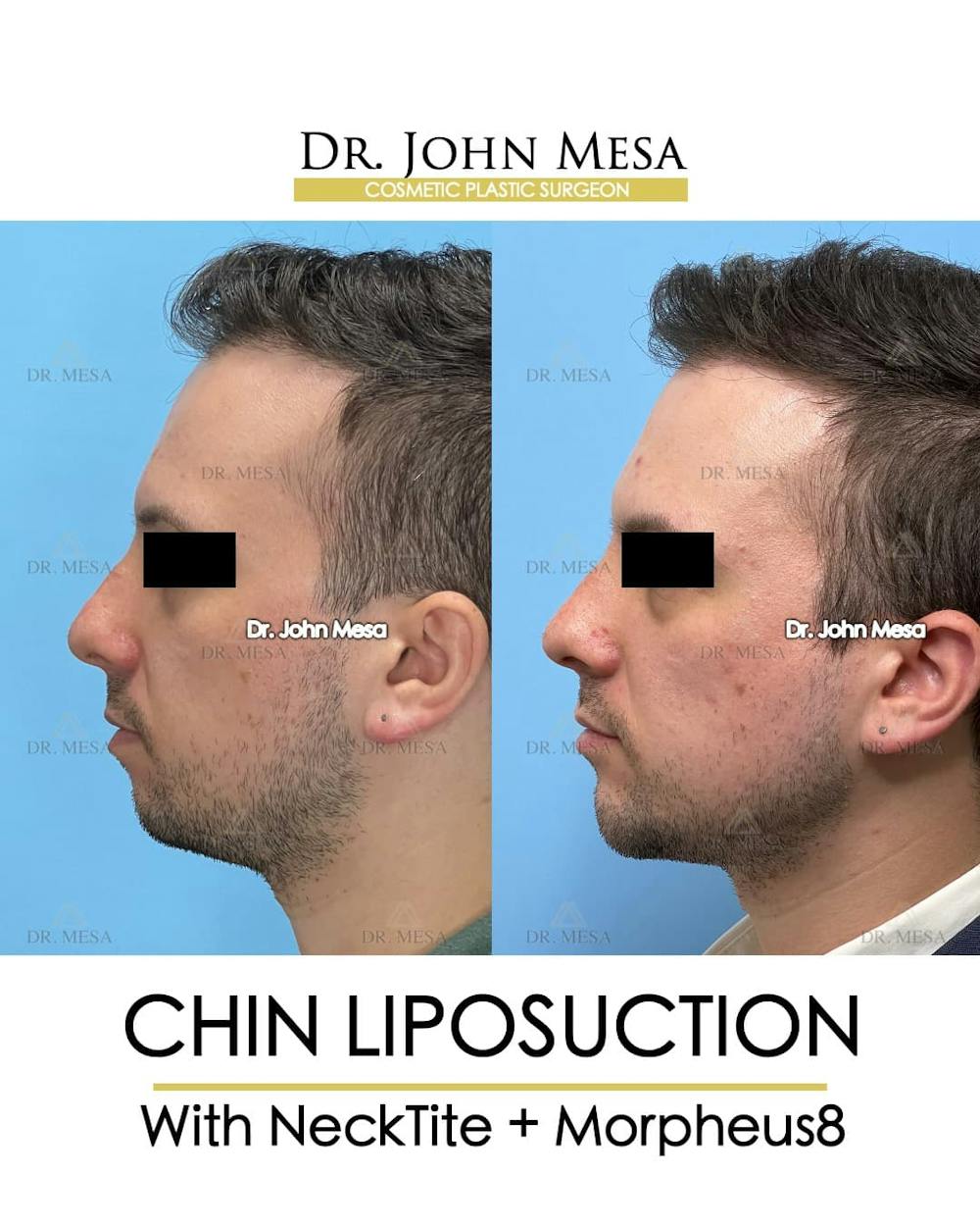 Chin Liposuction Before & After Gallery - Patient 143833 - Image 5