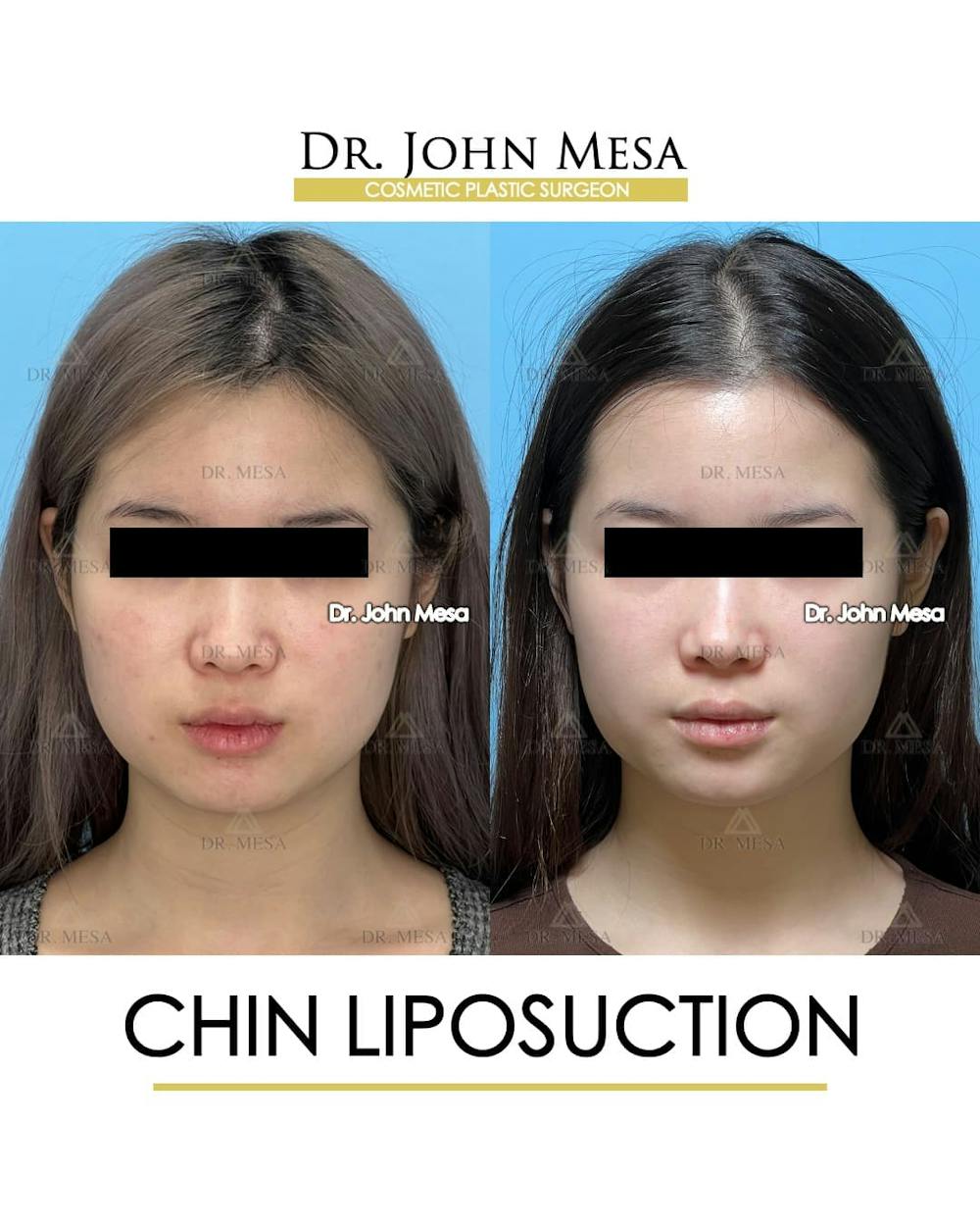 Chin Liposuction Before & After Gallery - Patient 394745 - Image 2