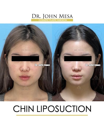 Chin Liposuction Before & After Gallery - Patient 394745 - Image 1