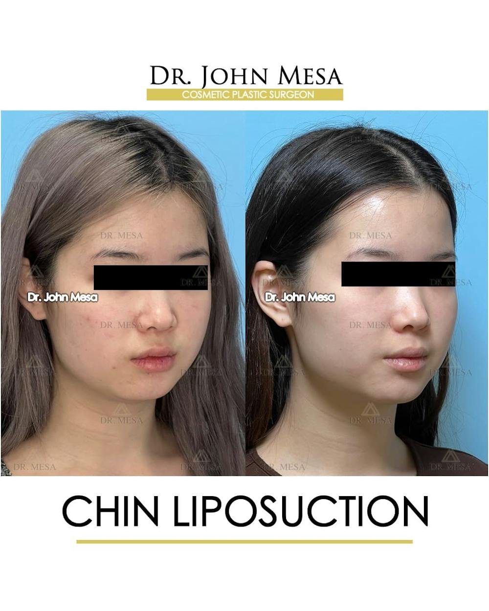 Chin Liposuction Before & After Gallery - Patient 394745 - Image 3