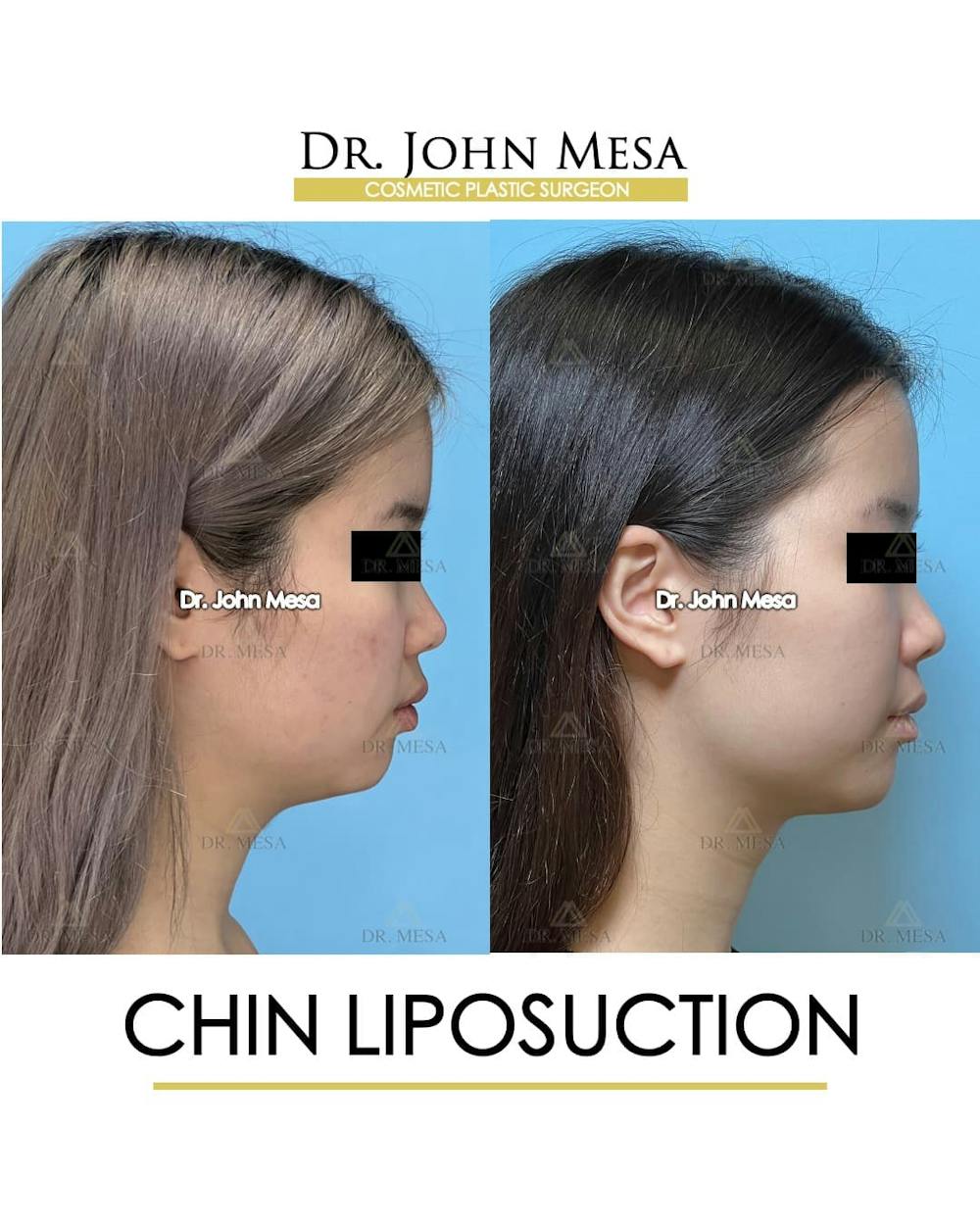 Chin Liposuction Before & After Gallery - Patient 394745 - Image 1