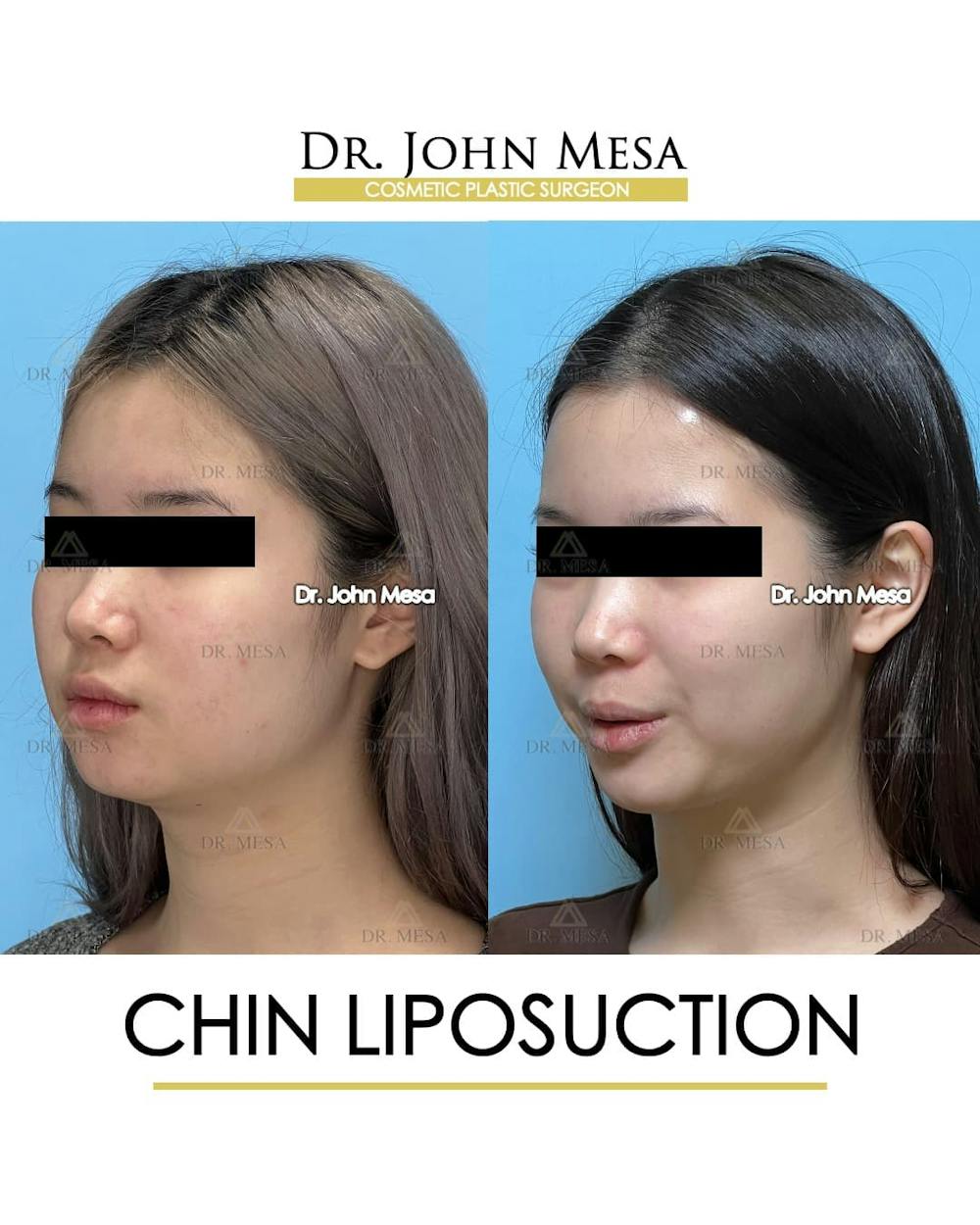 Chin Liposuction Before & After Gallery - Patient 394745 - Image 4