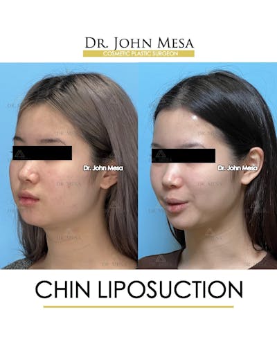Chin Liposuction Before & After Gallery - Patient 394745 - Image 4