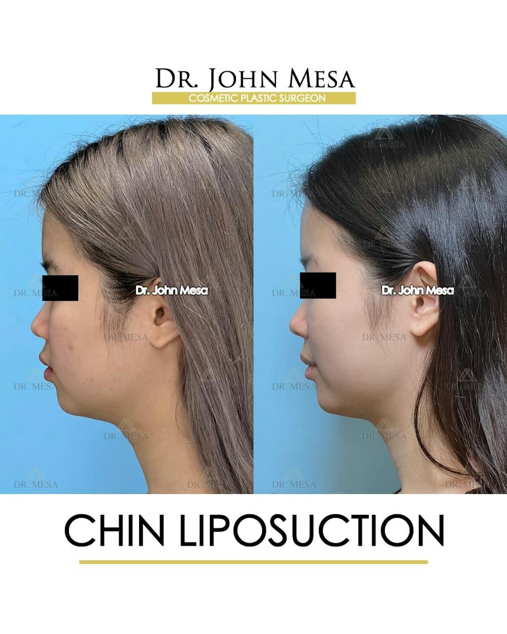 Chin Liposuction Before & After Gallery - Patient 394745 - Image 5