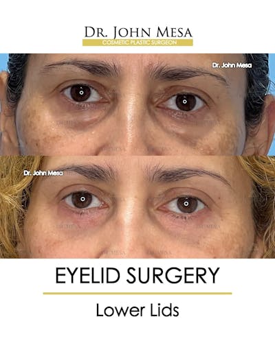 Eyelid Lift Surgery Before & After Gallery - Patient 215105 - Image 1