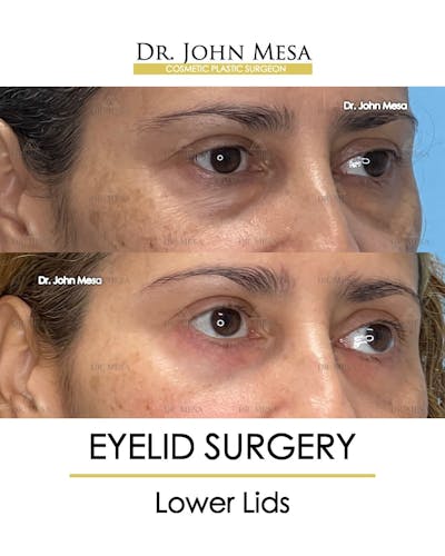 Eyelid Lift Surgery Before & After Gallery - Patient 215105 - Image 2