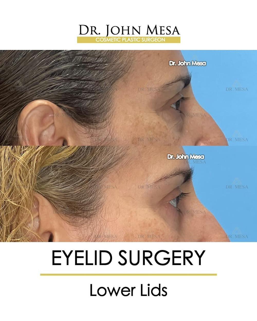 Eyelid Lift Surgery Before & After Gallery - Patient 215105 - Image 3