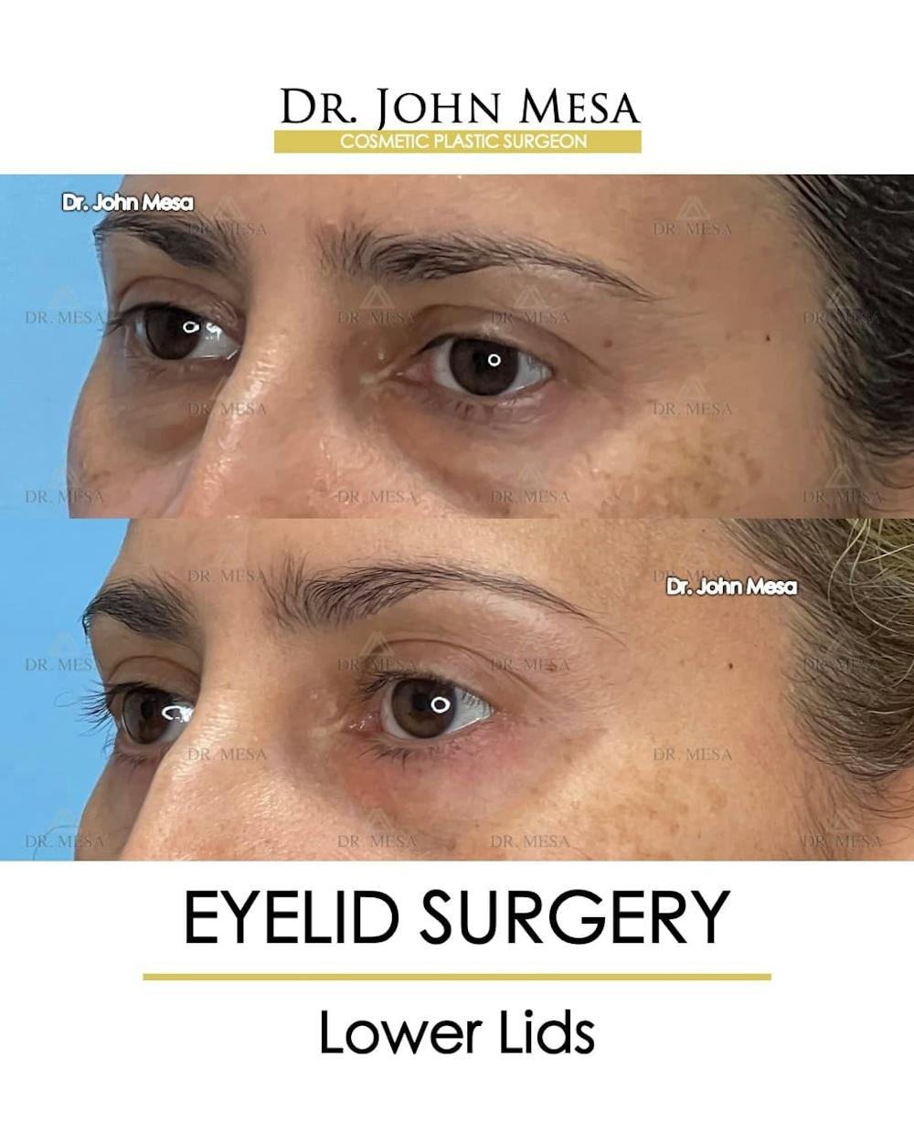 Eyelid Lift Surgery Before & After Gallery - Patient 215105 - Image 4