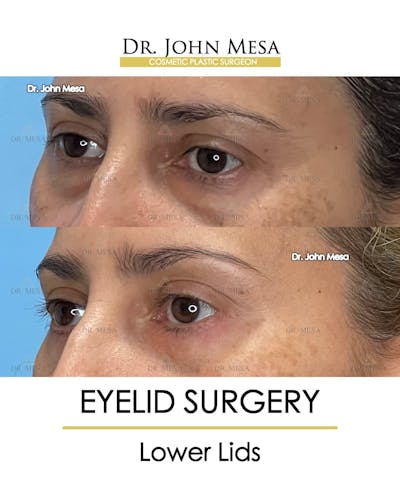 Eyelid Lift Surgery Before & After Gallery - Patient 215105 - Image 4