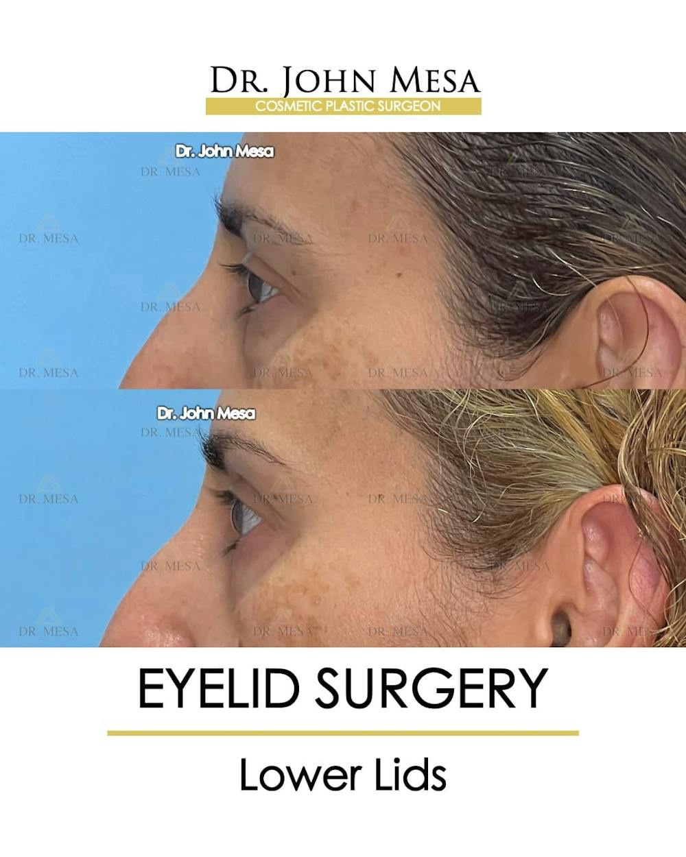 Eyelid Lift Surgery Before & After Gallery - Patient 215105 - Image 5