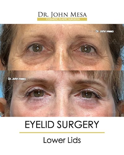 Eyelid Lift Surgery Before & After Gallery - Patient 207238 - Image 1