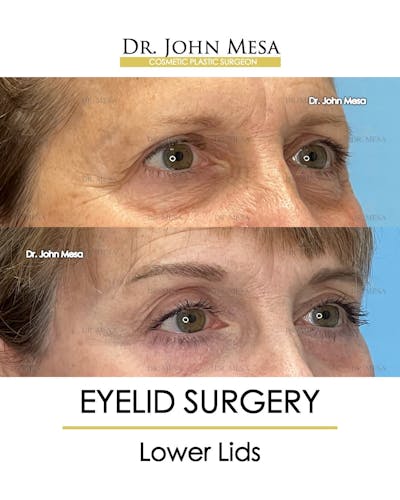 Eyelid Lift Surgery Before & After Gallery - Patient 207238 - Image 2