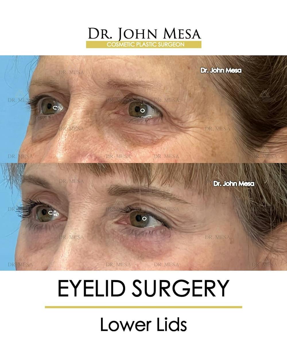 Eyelid Lift Surgery Before & After Gallery - Patient 207238 - Image 3