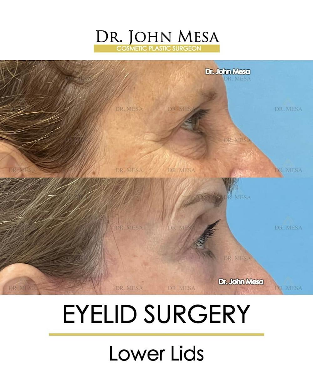 Eyelid Lift Surgery Before & After Gallery - Patient 207238 - Image 4