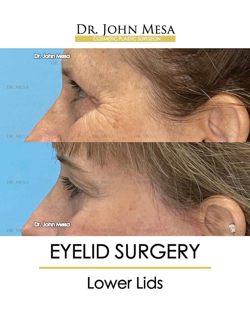Eyelid Lift Surgery Before & After Gallery - Patient 207238 - Image 5