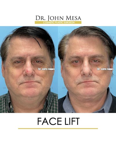 Facelift Before & After Gallery - Patient 968576 - Image 1