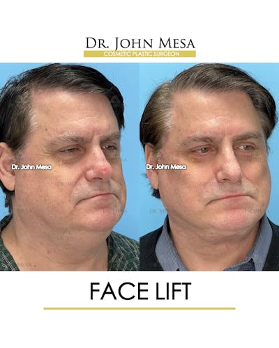 Facelift Before & After Gallery - Patient 968576 - Image 2