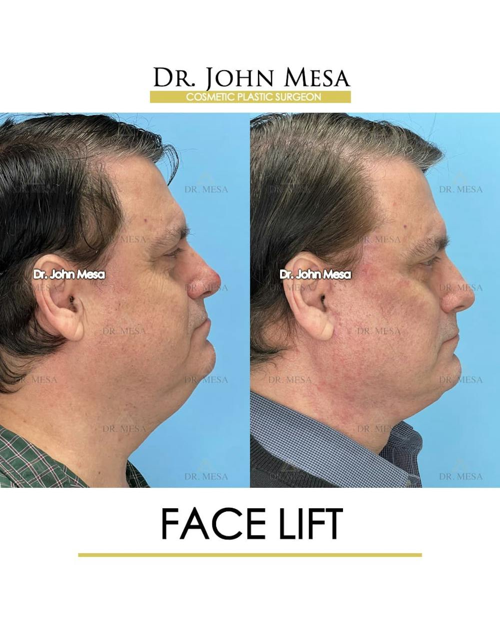 Facelift Before & After Gallery - Patient 968576 - Image 3