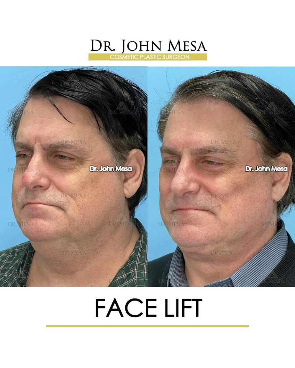 Facelift Before & After Gallery - Patient 968576 - Image 4