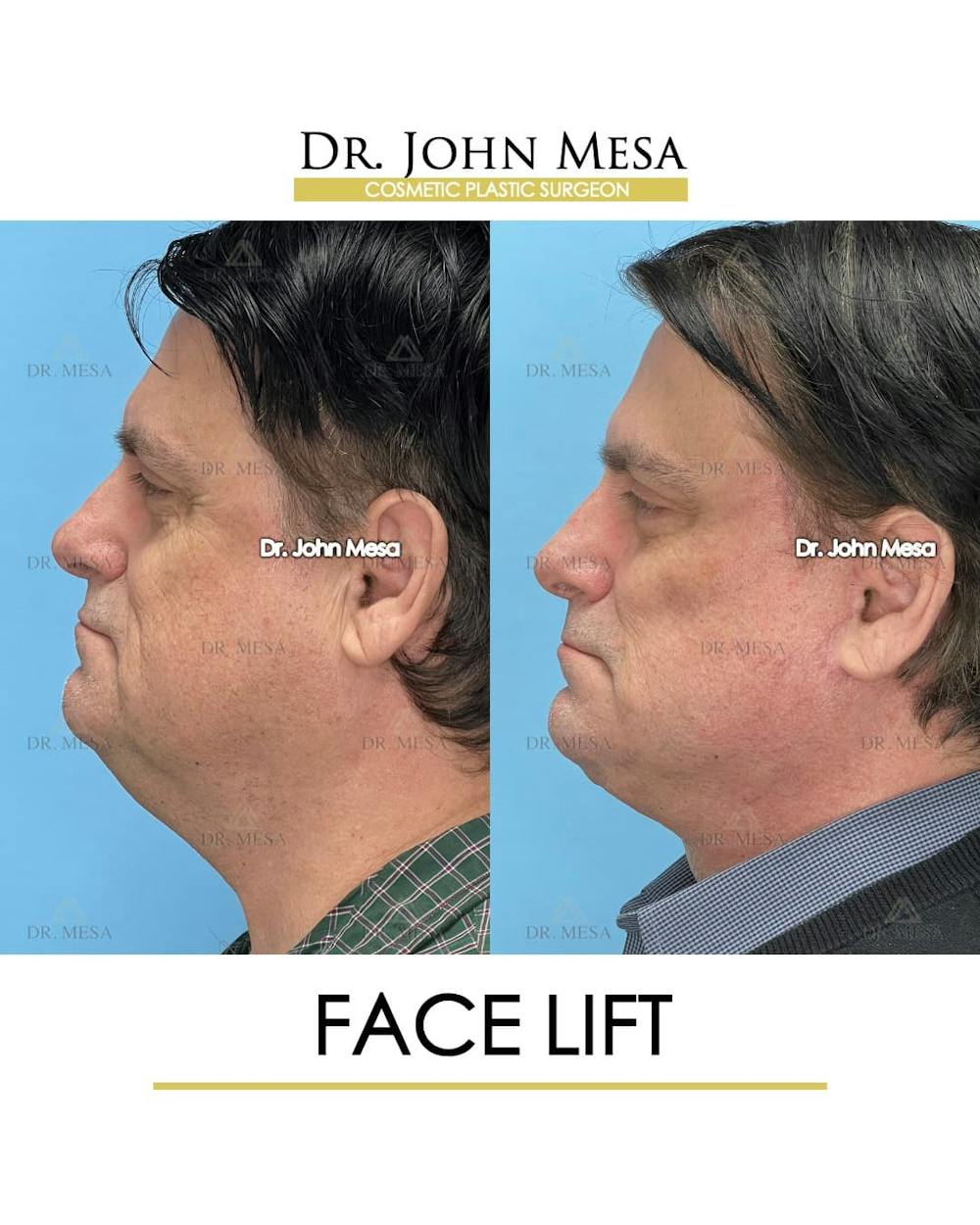 Facelift Before & After Gallery - Patient 968576 - Image 5