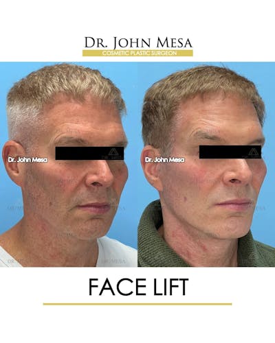 Facelift Before & After Gallery - Patient 543175 - Image 2