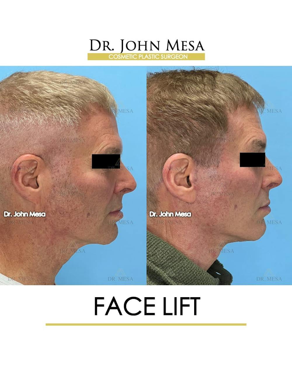 Facelift Before & After Gallery - Patient 543175 - Image 3