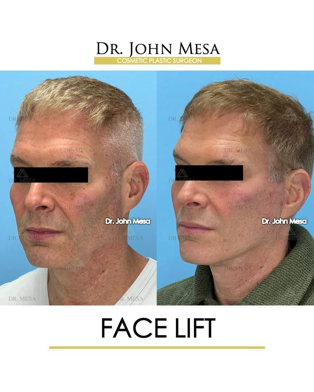 Facelift Before & After Gallery - Patient 543175 - Image 4