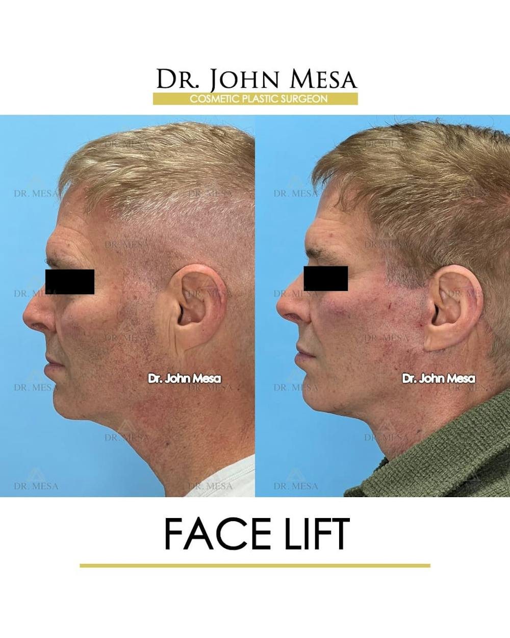 Facelift Before & After Gallery - Patient 543175 - Image 5