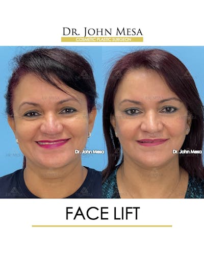 Facelift Before & After Gallery - Patient 131948 - Image 1