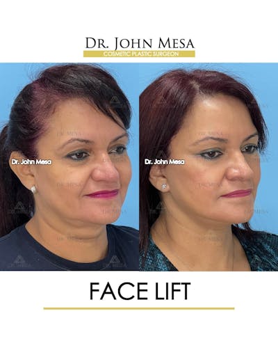 Facelift Before & After Gallery - Patient 131948 - Image 2