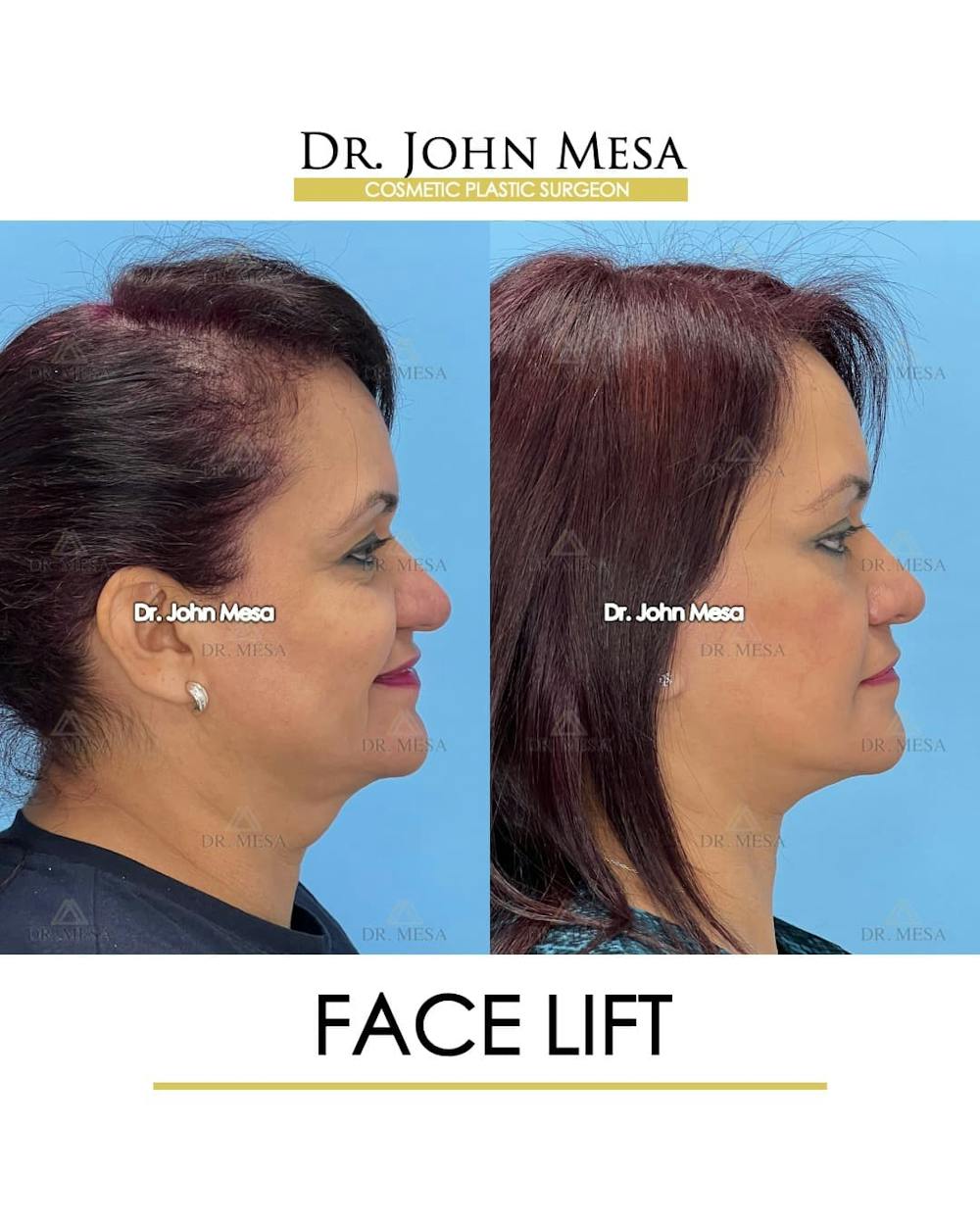 Facelift Before & After Gallery - Patient 131948 - Image 3