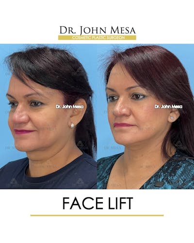 Facelift Before & After Gallery - Patient 131948 - Image 4