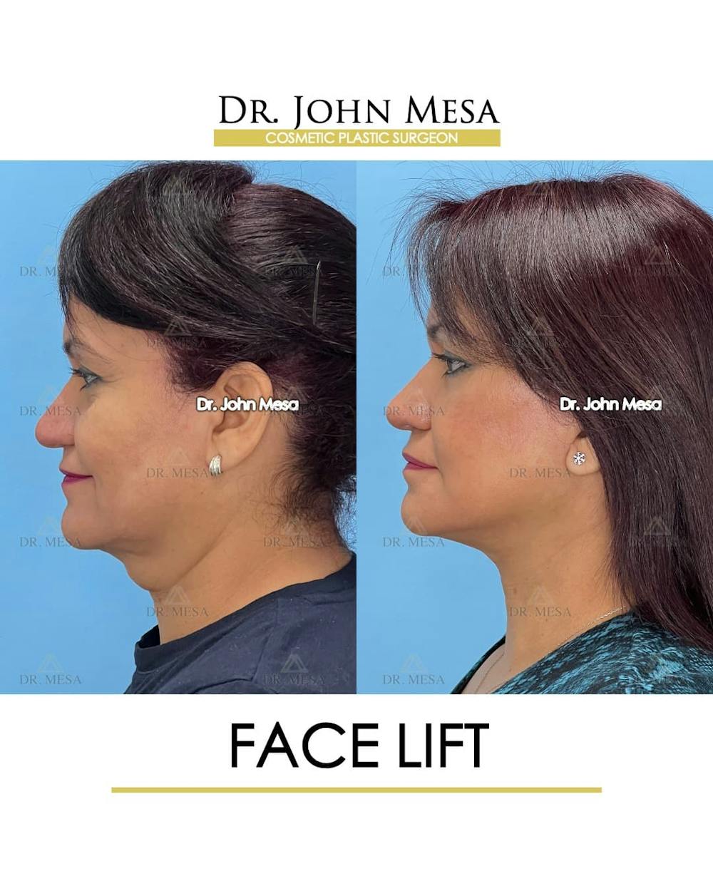 Facelift Before & After Gallery - Patient 131948 - Image 5