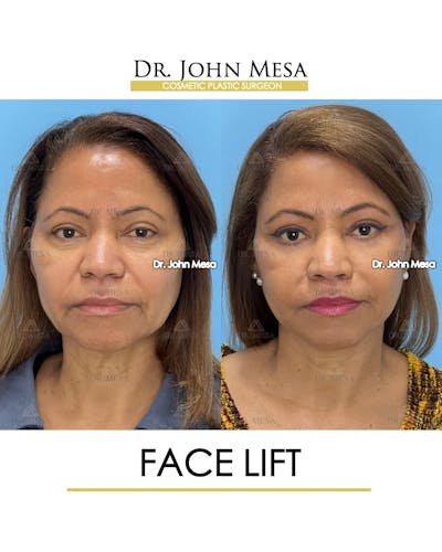Facelift Before & After Gallery - Patient 992411 - Image 1