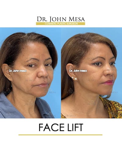 Facelift Before & After Gallery - Patient 992411 - Image 2