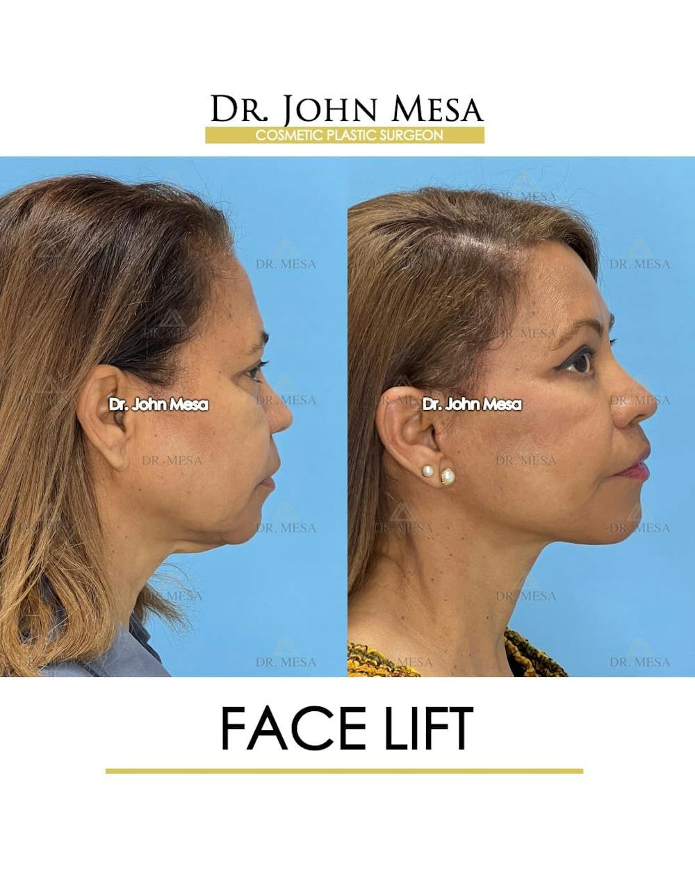 Facelift Before & After Gallery - Patient 992411 - Image 3