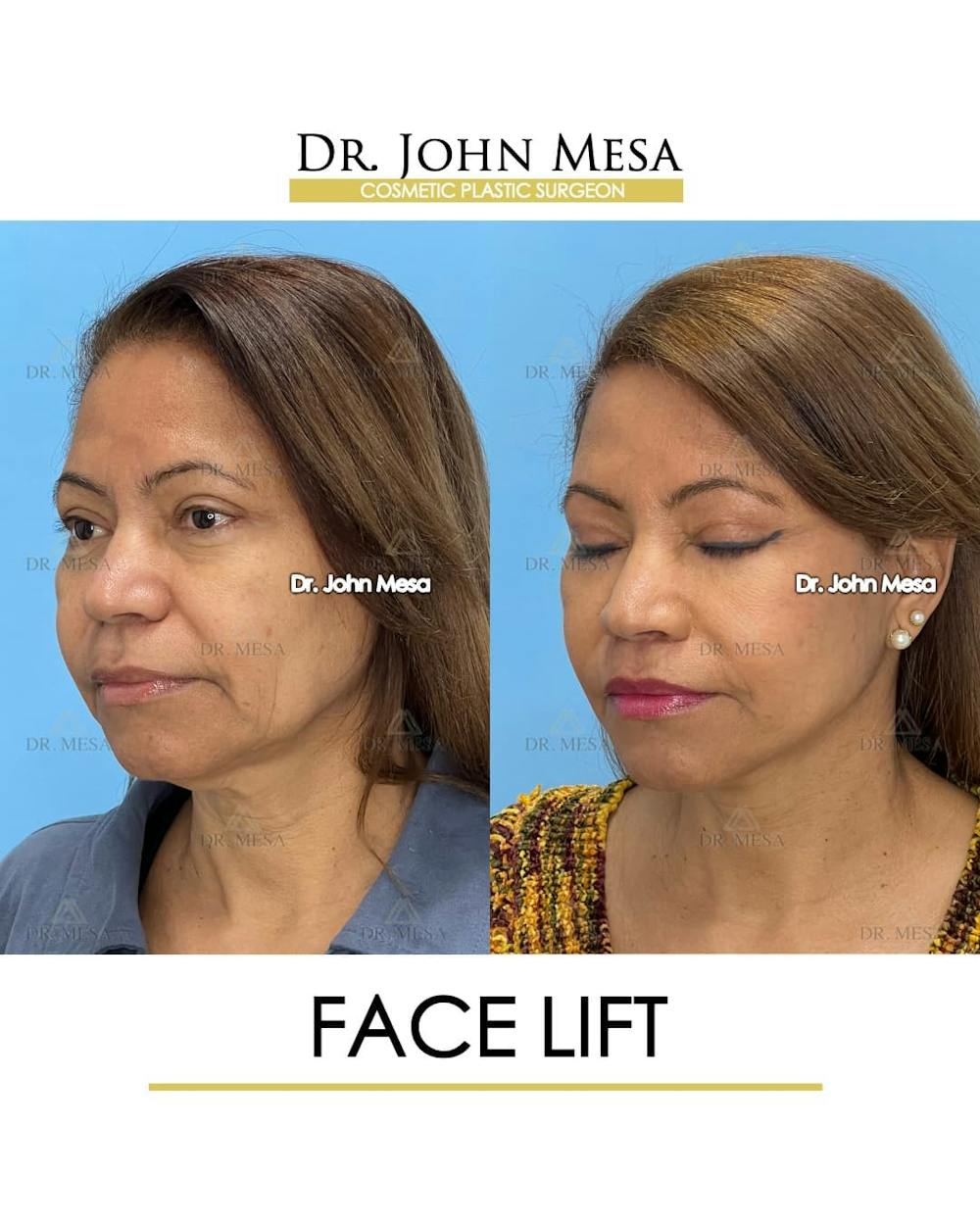 Facelift Before & After Gallery - Patient 992411 - Image 4