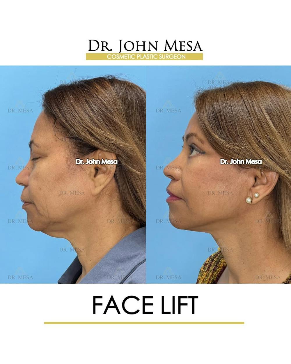 Facelift Before & After Gallery - Patient 992411 - Image 5