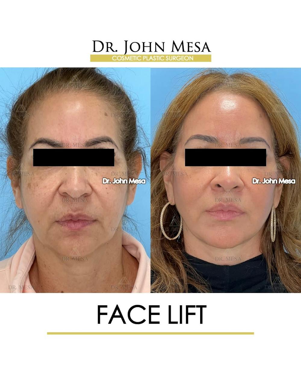 Facelift Before & After Gallery - Patient 357579 - Image 1