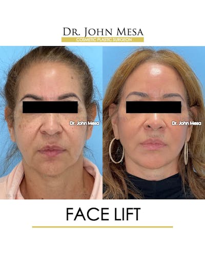 Facelift Before & After Gallery - Patient 357579 - Image 1