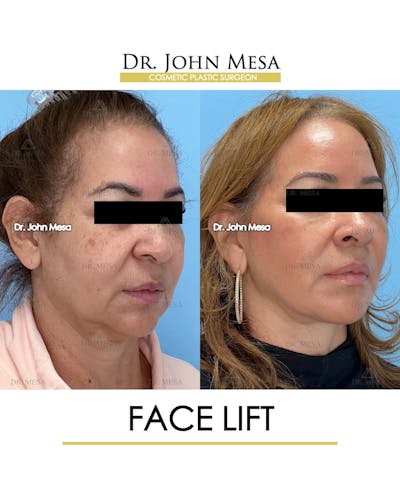 Facelift Before & After Gallery - Patient 357579 - Image 2
