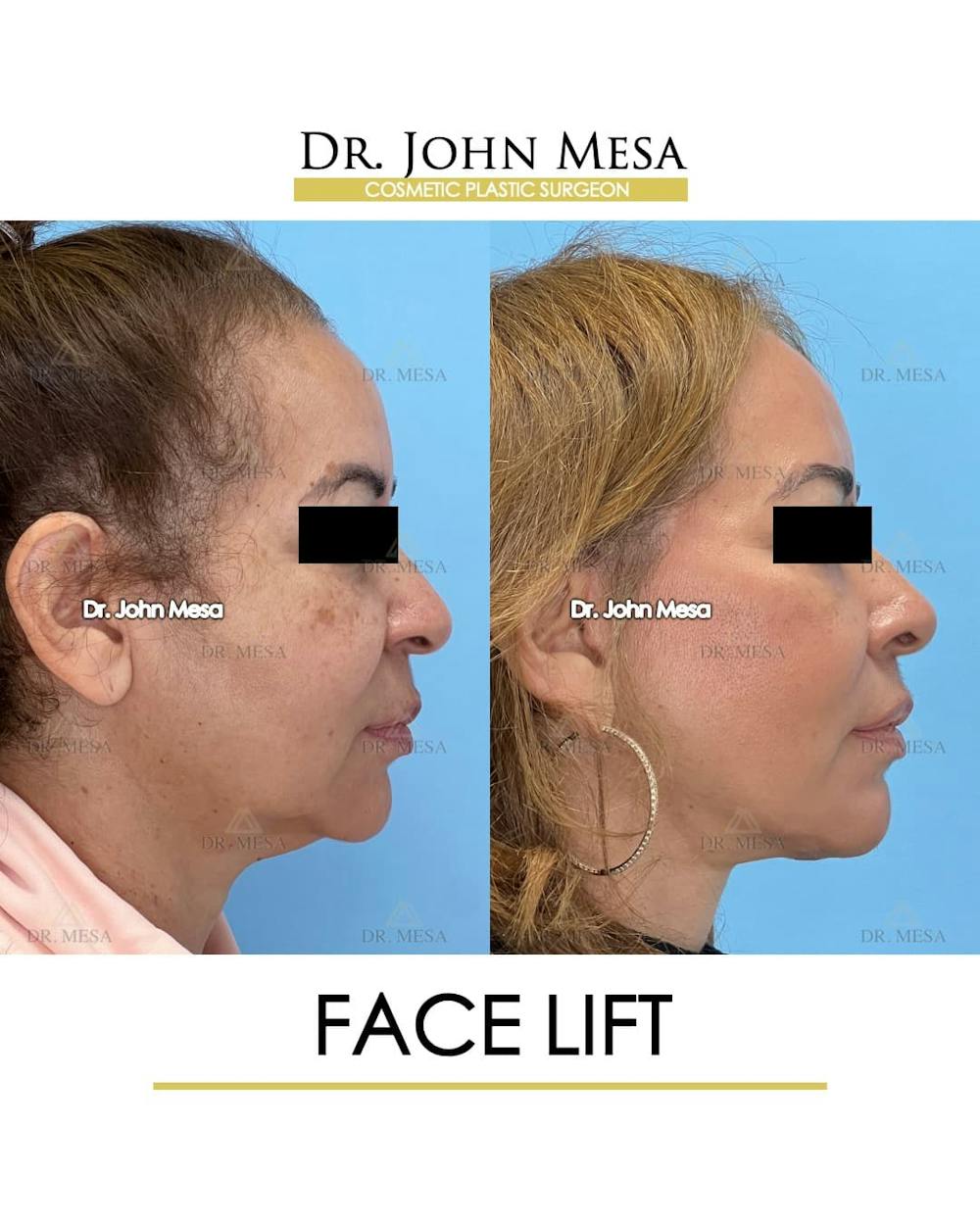 Facelift Before & After Gallery - Patient 357579 - Image 3