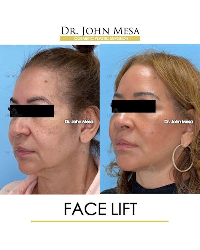 Facelift Before & After Gallery - Patient 357579 - Image 4