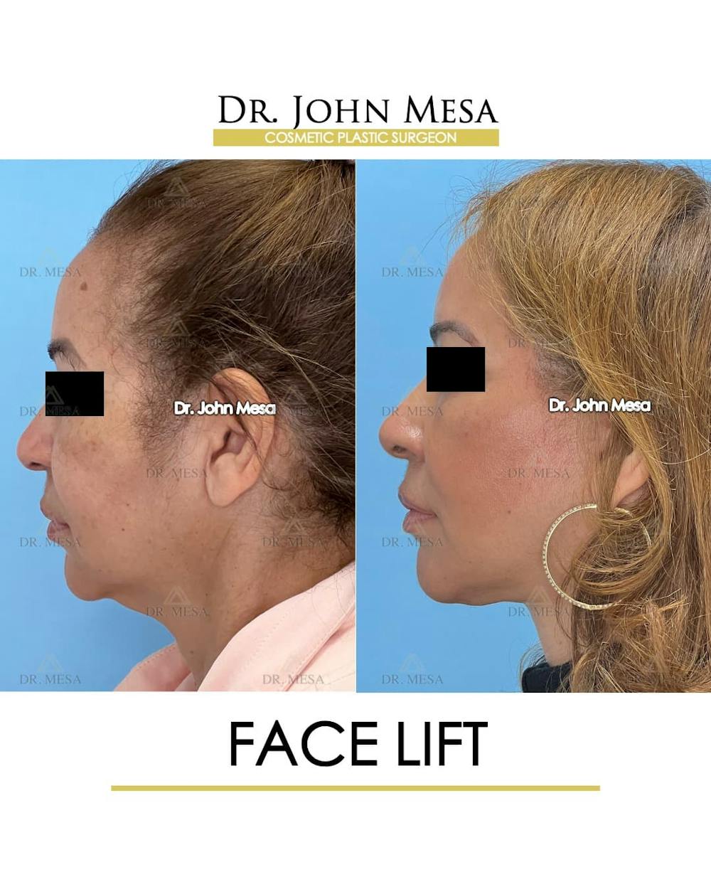 Facelift Before & After Gallery - Patient 357579 - Image 5