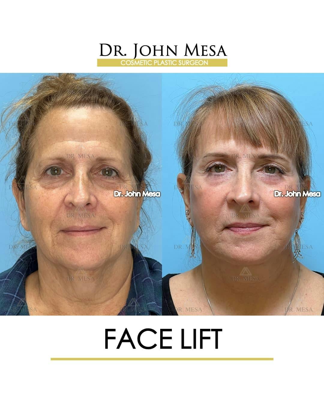 Facelift Before & After Gallery - Patient 305414 - Image 1