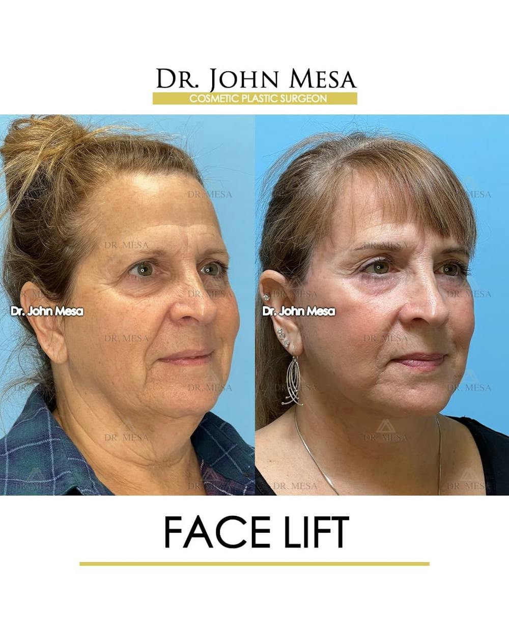 Facelift Before & After Gallery - Patient 305414 - Image 2