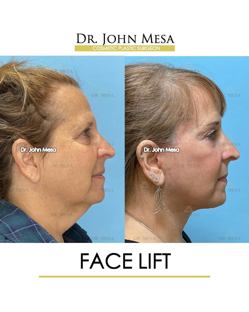 Facelift Before & After Gallery - Patient 305414 - Image 3