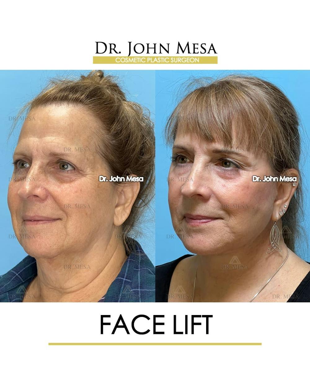 Facelift Before & After Gallery - Patient 305414 - Image 4
