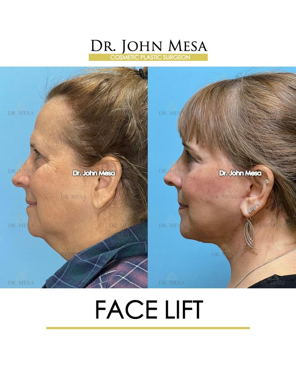 Facelift Before & After Gallery - Patient 305414 - Image 5
