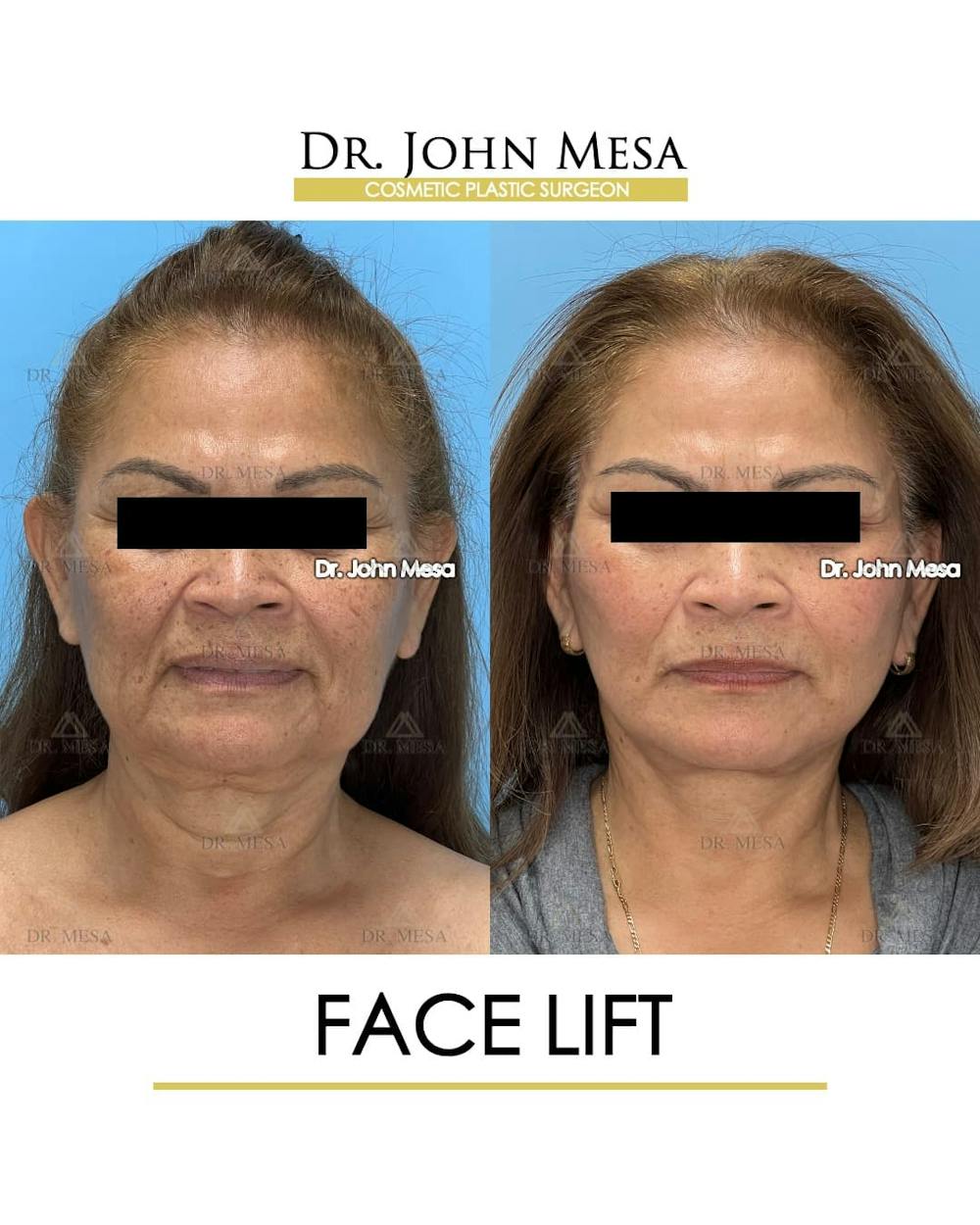 Facelift Before & After Gallery - Patient 218817 - Image 1